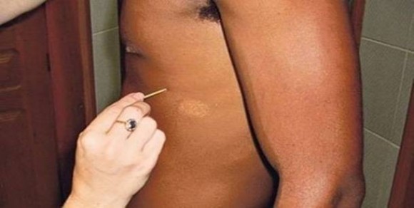 Imagem: hanseniase Secretaria promove campanha para consultas de doenças da pele