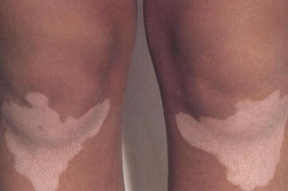 Imagem: VITILIGO Técnica aprimorada de tratamento do vitiligo é apresentada durante encontro de dermatologistas