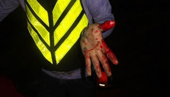 Mão da vítima -  Foto: José Antonio Araujo / AGORA MT