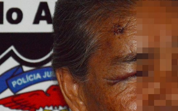 Marcas da coronhada na senhora de 70 anos - Foto: Ronaldo Teixeira / AGORA MT
