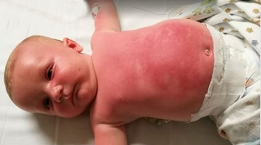 Imagem: bebe tem queimaduras após usar protetor infantil