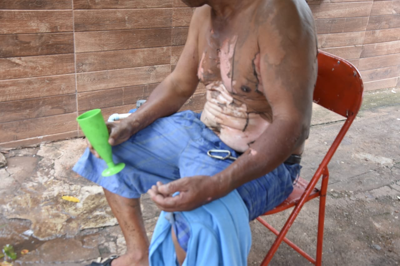 Imagem: home queimado Homem tem grande parte do corpo queimado ao colocar álcool em fogareiro