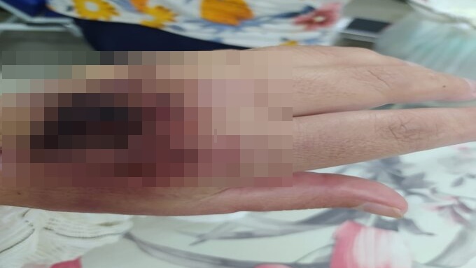 Imagem: mao mulher aguarda cirurgia Foto Assessoria Paciente com risco de morte aguarda por cirurgia há mais de 6 meses