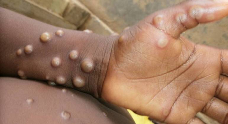 Imagem: variola macaco O que é a varíola do macaco, doença que deixa países europeus em alerta