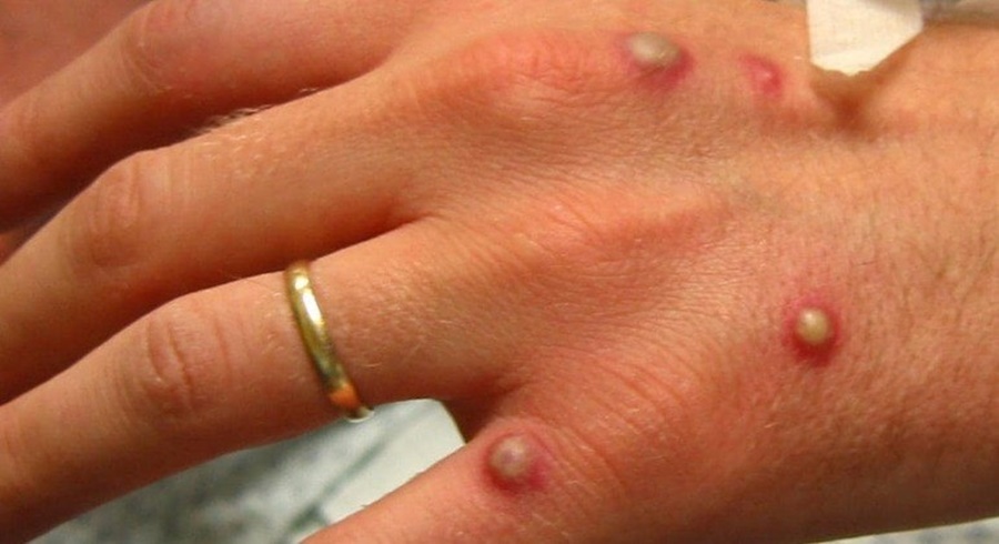 Imagem: Caso variola de macacos e confirmado no Brasil São Paulo confirma segundo caso de varíola dos macacos