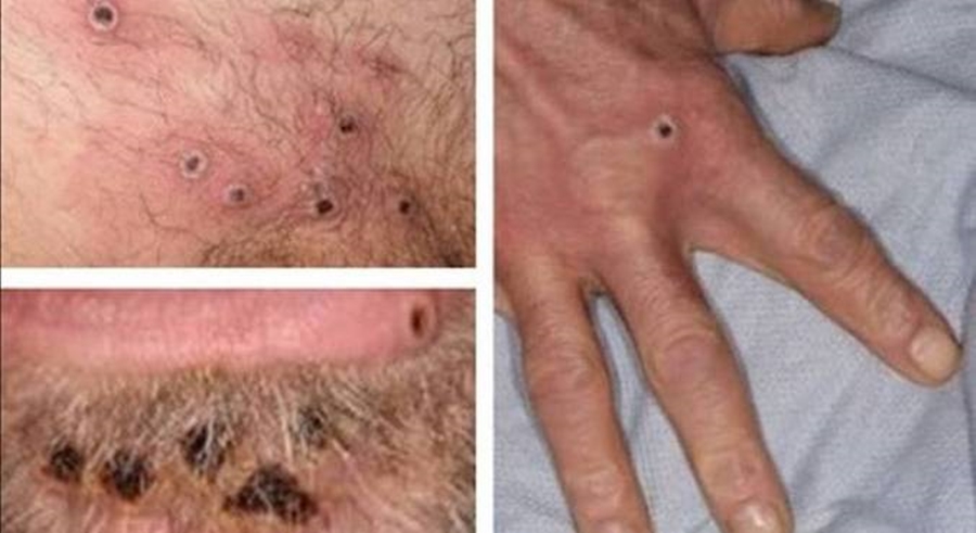 Imagem: variola macaco Brasil registra primeiros casos de transmissão comunitária da varíola do macaco