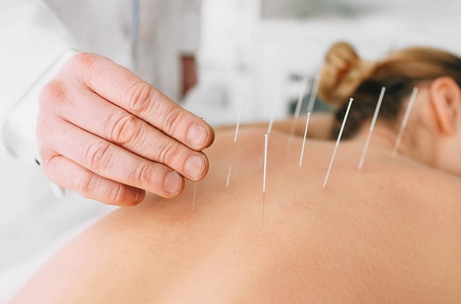 Imagem: acupuntura Acupuntura: quais as áreas beneficiadas por essa terapia?