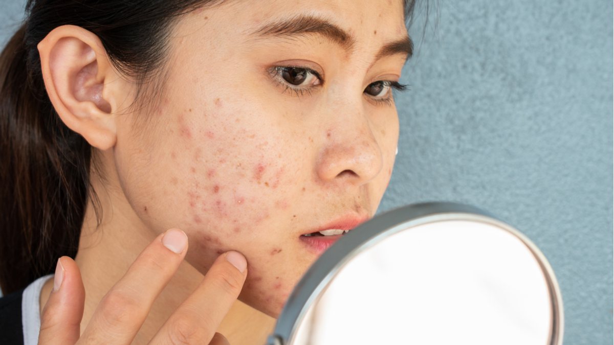 Imagem: acne na mulher adulta Sinais na pele: 5 indícios de que algo pode estar errado com o seu corpo